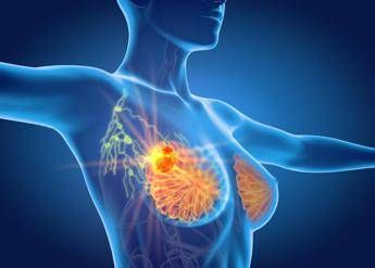 Per cancro seno la cura che arriva dal gelo, Ieo: &quot;Verso un futuro no bisturi&quot;