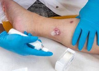 Idrosadenite suppurativa, quando fare la doccia o dormire diventano ostacoli