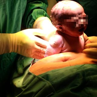 Papà accanto alla mamma anche durante i cesarei: nascita più &quot;dolce&quot; e inclusiva al Policlinico di Milano