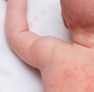 Milano, bimba ferita dallo spray della madre: violenza preoccupante