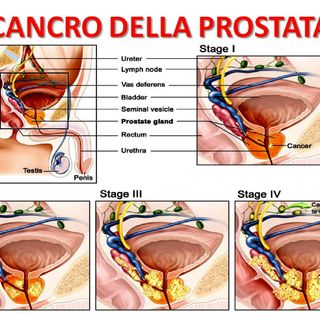 Cancro alla prostata, cura innovativa alla Città di Pavia