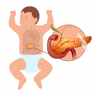Milano: bimbo di tre mesi operato al pancreas, successo dell’intervento