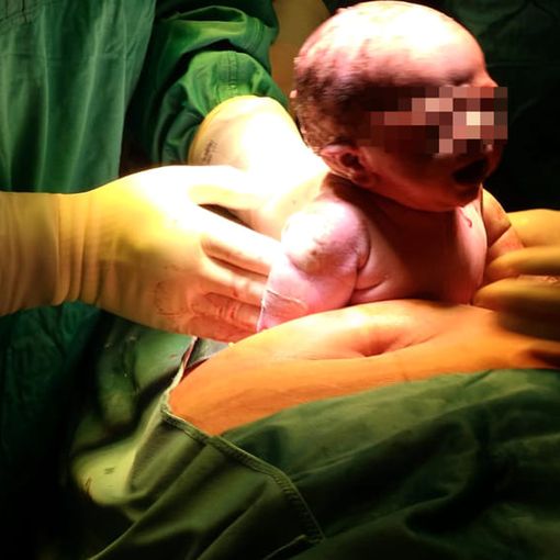 Papà accanto alla mamma anche durante i cesarei: nascita più &quot;dolce&quot; e inclusiva al Policlinico di Milano