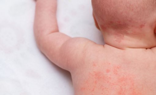 Milano, bimba ferita dallo spray della madre: violenza preoccupante