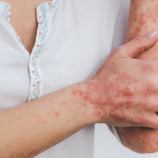 La rubrica della dietista Manuela Cimorelli: Psoriasi, conosciamola meglio e viviamoci al meglio