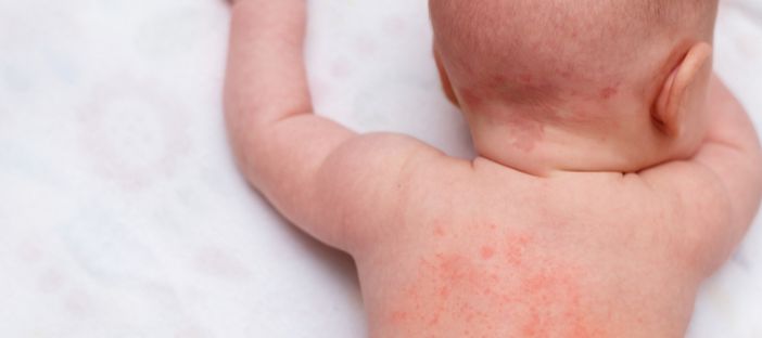 Milano, bimba ferita dallo spray della madre: violenza preoccupante