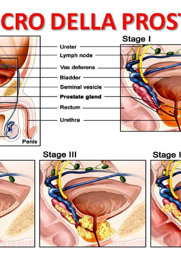 Cancro alla prostata, cura innovativa alla Città di Pavia