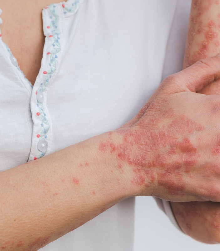 La rubrica della dietista Manuela Cimorelli: Psoriasi, conosciamola meglio e viviamoci al meglio