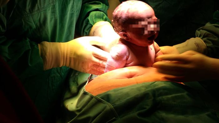 Papà accanto alla mamma anche durante i cesarei: nascita più &quot;dolce&quot; e inclusiva al Policlinico di Milano