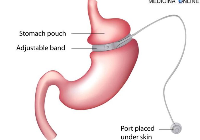 Vigevano, 69enne muore dopo operazione per perdita di peso