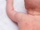 Milano, bimba ferita dallo spray della madre: violenza preoccupante