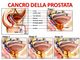 Cancro alla prostata, cura innovativa alla Città di Pavia