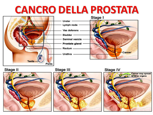 Cancro alla prostata, cura innovativa alla Città di Pavia