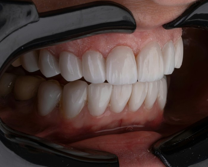 Estetica del sorriso, i numeri in crescita di una tendenza trasversale