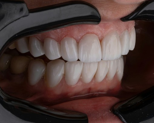 Estetica del sorriso, i numeri in crescita di una tendenza trasversale
