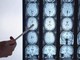 Di Battista e il tumore al cervello, in Italia circa 6mila diagnosi ogni anno: quali sono i sintomi 'spia' Di Battista e il tumore al cervello, in Italia circa 6mila diagnosi ogni anno: quali sono i sintomi 'spia'