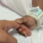 Gemelle siamesi separate al Gaslini di Genova: &quot;Estubate, respirano da sole&quot;