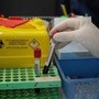 Alzheimer, via libera a test del sangue per diagnosi: cosa significa