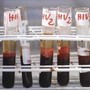 Hiv, il 90% dei pazienti sceglie terapia long acting