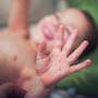 Morbillo, aumentano casi e ricoveri. Bassetti: "In Liguria focolaio senza precedenti, l'Italia rischia gravissima epidemia"