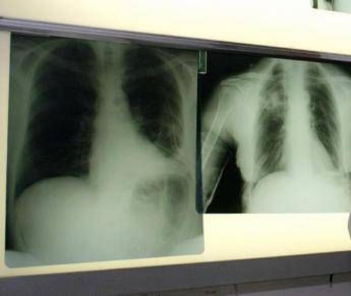 Bpco, ok dell'Ema alla prima terapia con propellente green