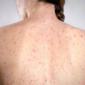 Morbillo, è allarme negli Usa. Italia prima per casi in Europa in in primi 6 mesi 2026 Morbillo, è allarme negli Usa. Italia prima per casi in Europa in in primi 6 mesi 2026