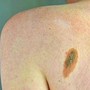 Ogni anno in Italia 2.600 casi ereditari di melanoma, Imi:"Prevenzione con test genetici e controlli"
