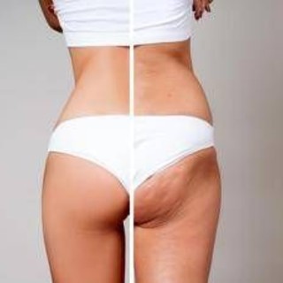Gambe gonfie e cellulite per 8 donne su 10: la cura riparte dal sistema linfatico