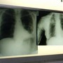 Bpco, ok dell'Ema alla prima terapia con propellente green