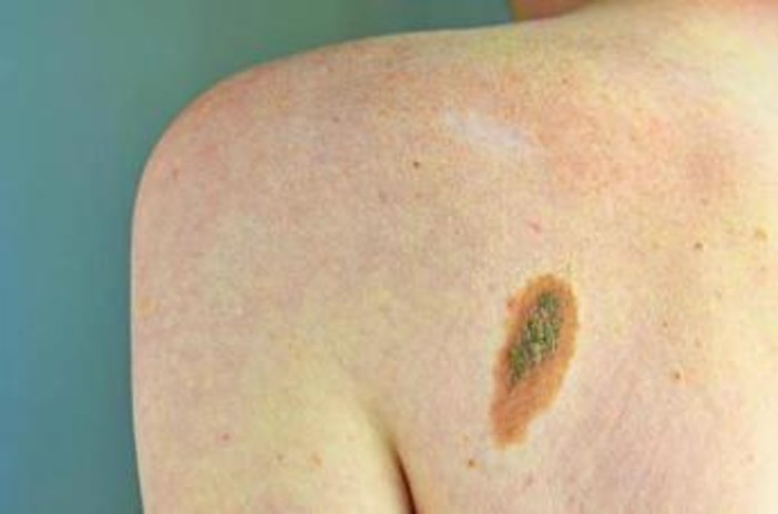 Melanoma, Adoi: "Bene nuova legge su prevenzione, dermatologo centrale in screening"