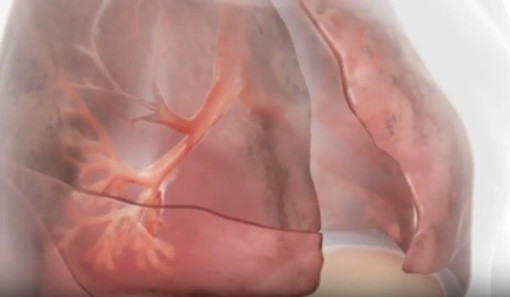 Innovazioni terapeutiche nella BPCO con enfisema Innovazioni terapeutiche nella BPCO con enfisema