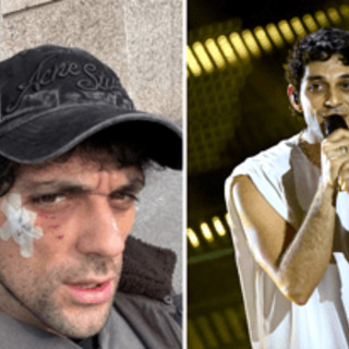 Bresh ferito al volto da un Dobermann, come sta il cantante