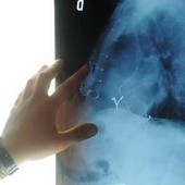 Radiologia interventistica, Ssn e fondazioni per cure più accessibili Radiologia interventistica, Ssn e fondazioni per cure più accessibili