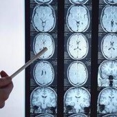 Di Battista e il tumore al cervello, in Italia circa 6mila diagnosi ogni anno: quali sono i sintomi 'spia'