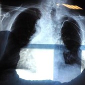 Bpco, pazienti e Cittadinanzattiva: "Aggiornamento Nota 99 favorisce cure eque" Bpco, pazienti e Cittadinanzattiva: "Aggiornamento Nota 99 favorisce cure eque"