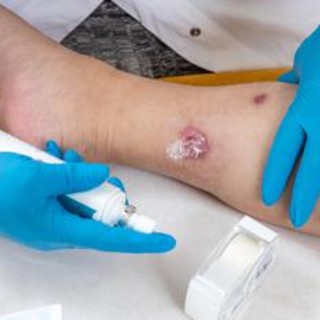Idrosadenite suppurativa, le iniziative di Ucb per migliorare diagnosi e cura Idrosadenite suppurativa, le iniziative di Ucb per migliorare diagnosi e cura