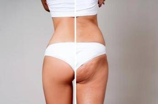 Gambe gonfie e cellulite per 8 donne su 10: la cura riparte dal sistema linfatico