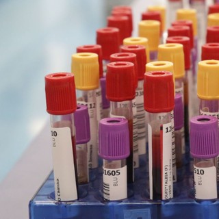 Botulino, dal 2001 al 2024 segnalati 1.276 casi in Italia