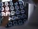 Rallentare l'Alzheimer con il litio, scoperta la 'scintilla' che innesca la patologia?