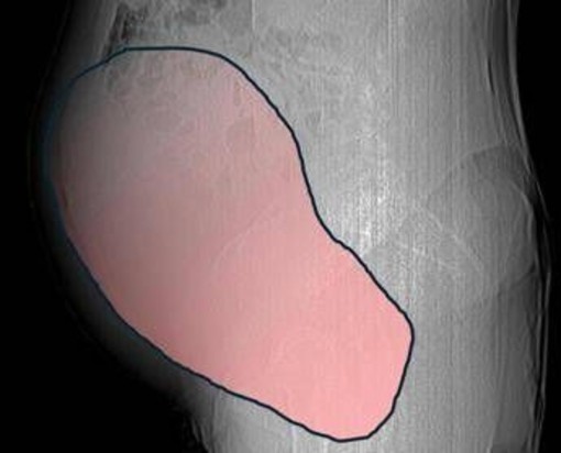 Intervento record al Sant'Anna di Torino, rimosso tumore ovarico di 6 kg