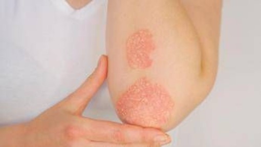 Giornata psoriasi, Ucb rinnova l'impegno contro lo stigma Giornata psoriasi, Ucb rinnova l'impegno contro lo stigma