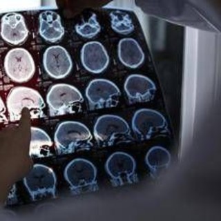 Rallentare l'Alzheimer con il litio, scoperta la 'scintilla' che innesca la patologia?