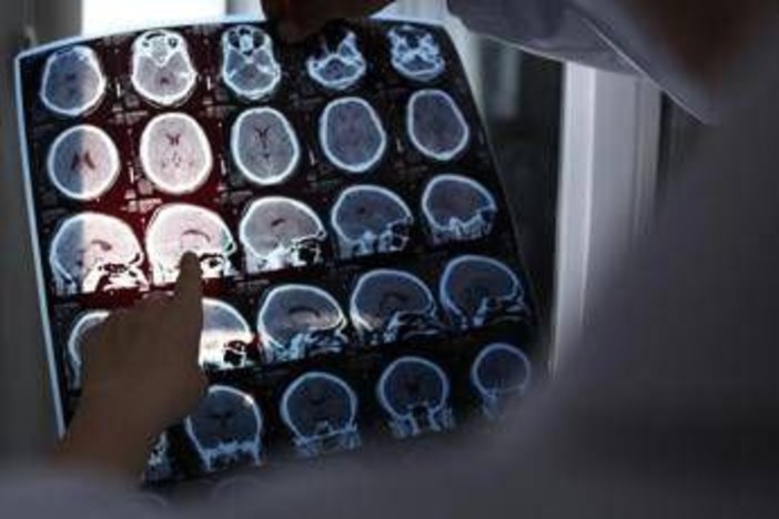 Rallentare l'Alzheimer con il litio, scoperta la 'scintilla' che innesca la patologia?