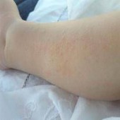 Dermatite atopica, Aifa estende rimborso di upadacitinib dai 12 anni di età